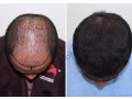 best-hair-transplant-in-bangalore-hair-transplant-clinic-small-1