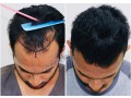 best-hair-transplant-in-bangalore-hair-transplant-clinic-small-3