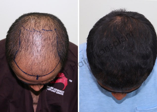 best-hair-transplant-in-bangalore-hair-transplant-clinic-big-1