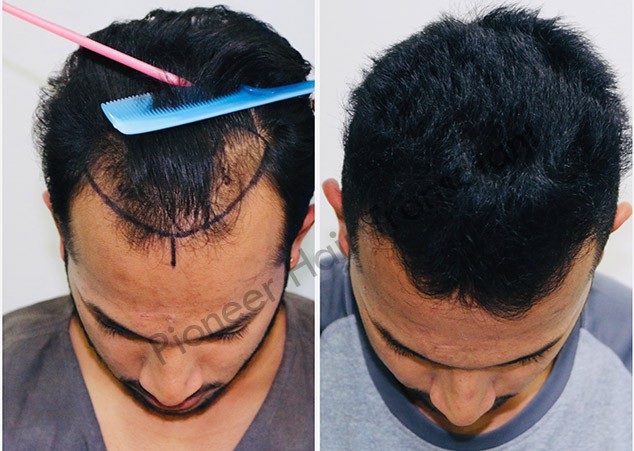 best-hair-transplant-in-bangalore-hair-transplant-clinic-big-3